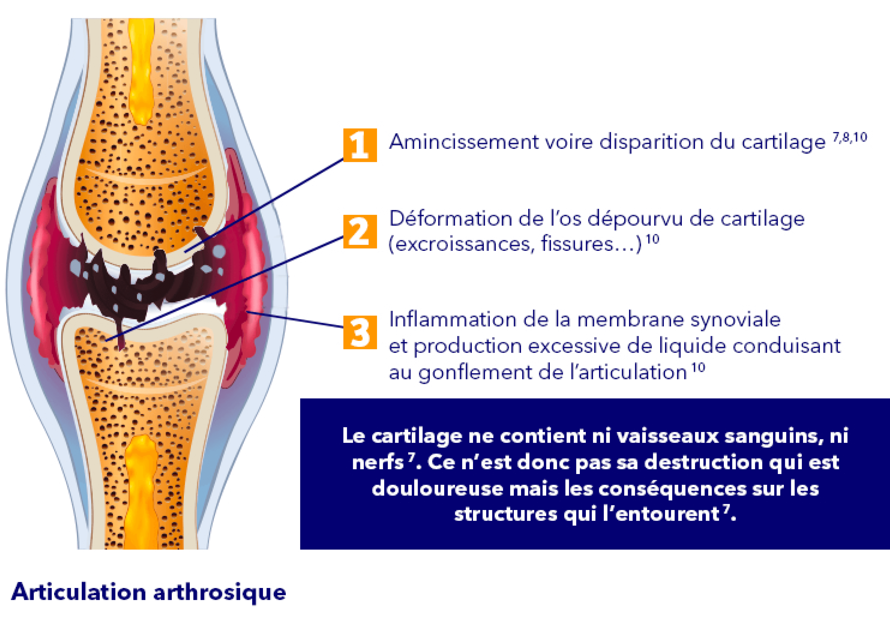 Arthrose définition - Qu'est-ce que l'arthrose du genou ?